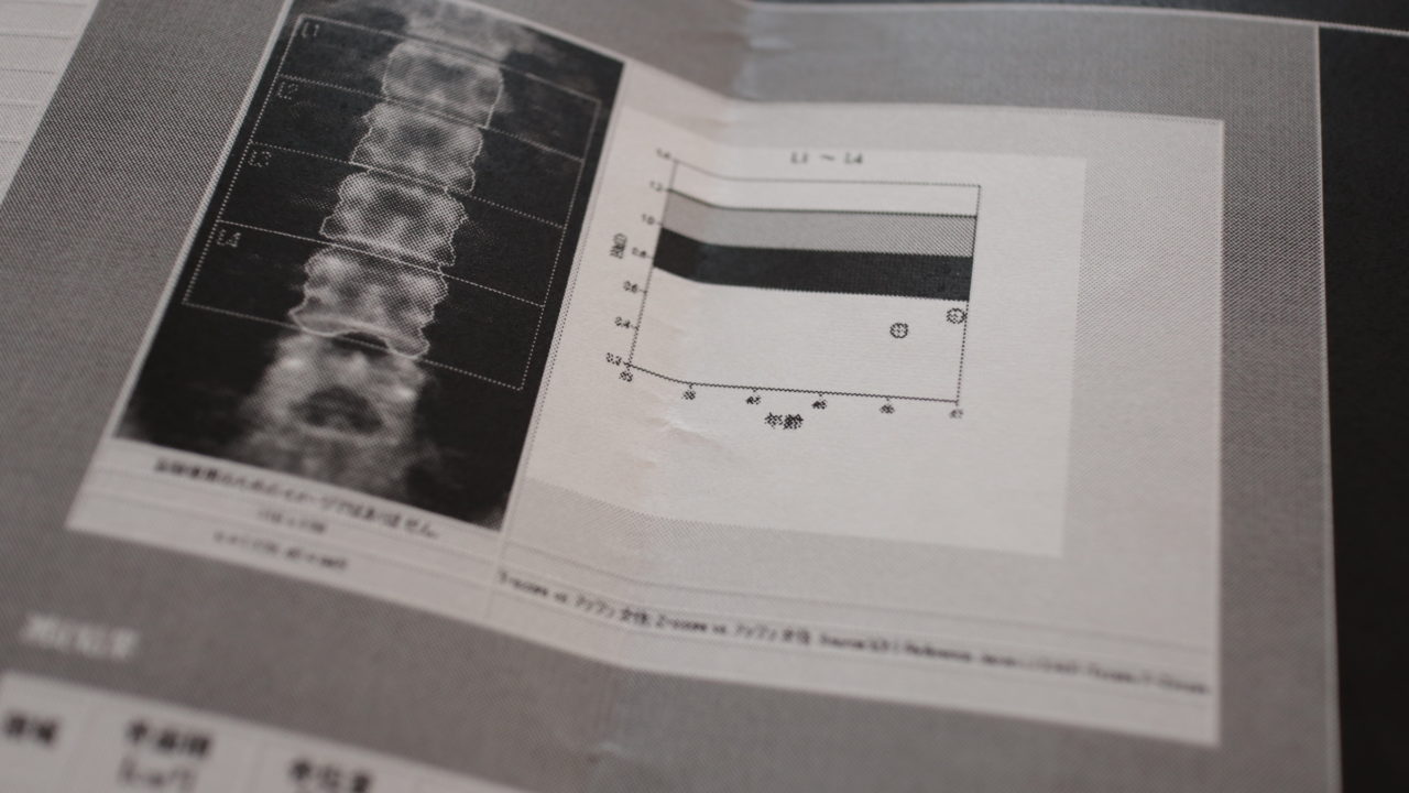 骨粗鬆症治療の新薬「イベニティ」治療経過レポート