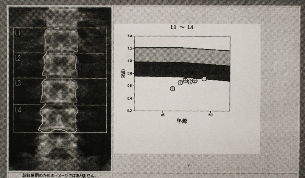 骨粗しょう症治療開始から3年、経過レポート